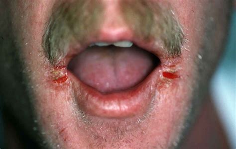 Causes of Angular Cheilitis - MEDizzy