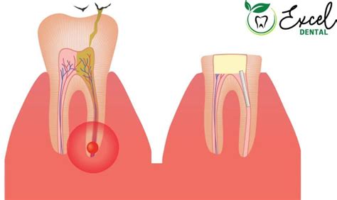 Know The Signs of a Root Canal Infection