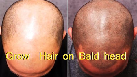 Grow Hair on Bald head - SIMPLE METHOD | Grow hair, Beauty hacks, Bald heads