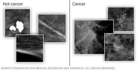 Mammogram - Mayo Clinic