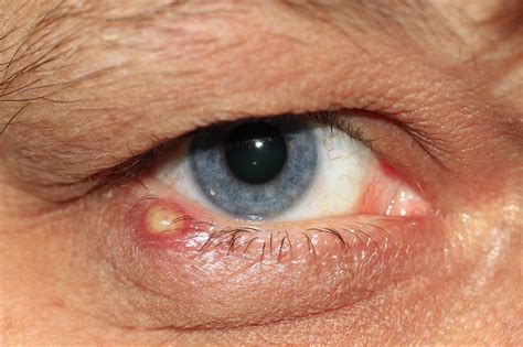 Eyelid Fungal Infection