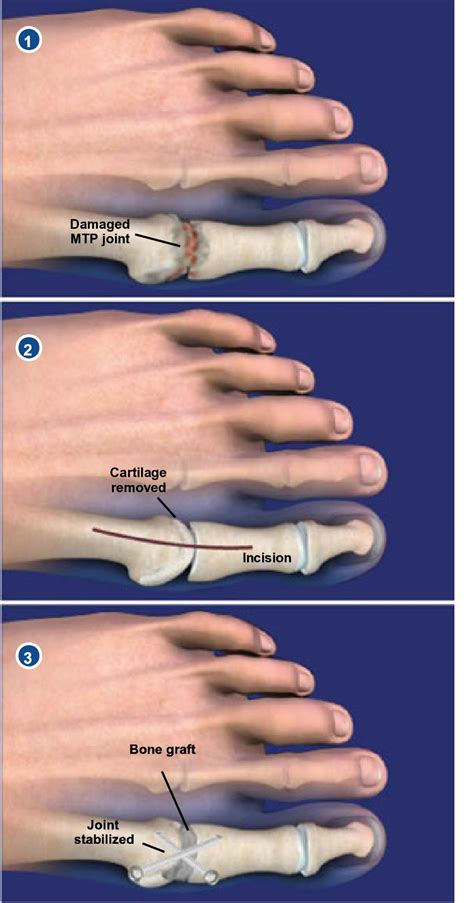 Great Toe Mtp Joint