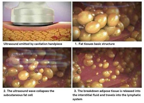 The Truth About Ultrasonic Cavitation: Benefits and Risks - Doctor Mier