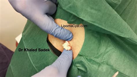 Cyst Removal from Back. LipomaCyst.com Dr Khaled Sadek - YouTube