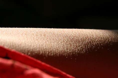 Skin care Tips for those with Dry Skin (Preventative) - Battle Eczema