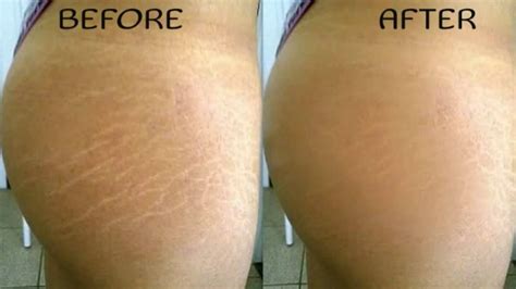 How to Naturally Get Rid of Stretch Marks