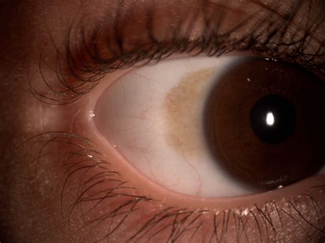 Miranza IOA: MELANOSIS CONJUNTIVAL