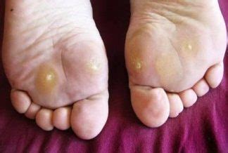 Corn Removal Products – Best, Toe, Reviews, Foot Corn Removal Products