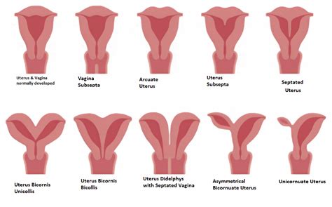 What is Complete Uterus Didelphys and How Does It Affect Pregnancy in 6 Ways?