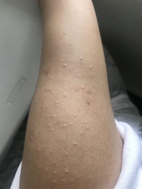 [Skin Concern] there are white bumps on my both my arms and my ...