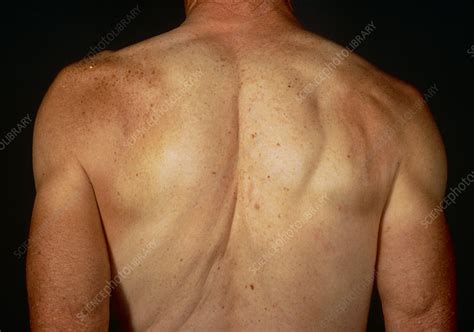 Dislocation of the shoulder - Stock Image - M330/0097 - Science Photo ...