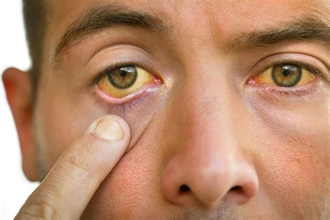 High Cholesterol: Your Eyes Can Detect These 3 Warning Signs of Bad