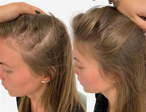 Hair Loss for Women | Female hair loss Treatment