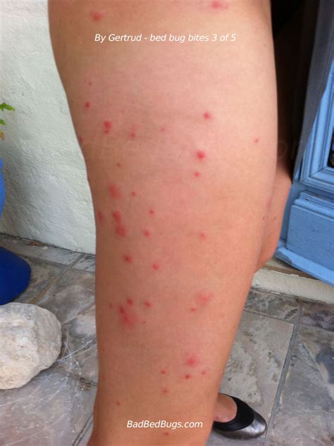 How Long After Bed Bug Bite Do Symptoms Appear at Katie Watkins blog