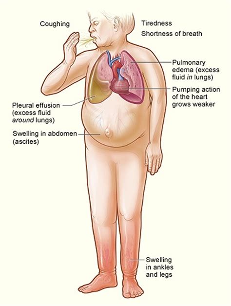 What is Congestive Heart Failure - Stages, Causes, Signs, Symptoms