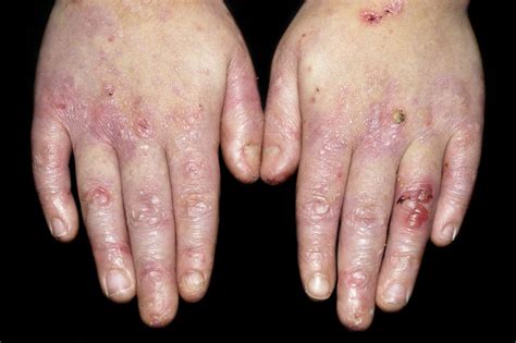 Epidermólisis ampollosa - Trastornos dermatológicos - Manual MSD ...