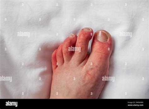 Chilblains on toes, red itchy bumps, swelling Foot of person with ...