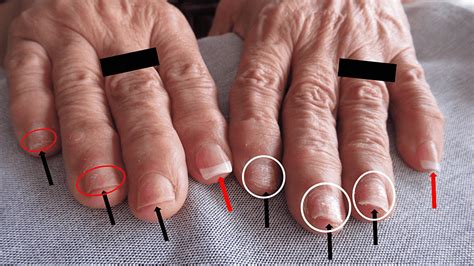 Cureus | Nailing the Diagnosis: Onychotillomania in Patients With Artificial Nails—An ...