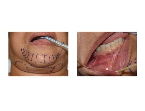 Plastic Surgery Case Study - Female Chin Implant Revision - Explore Plastic Surgery