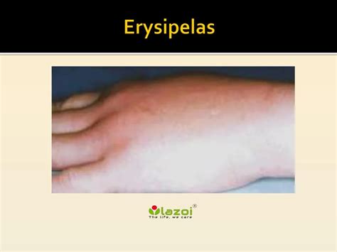 PPT - Erysipelas: Symptoms, Causes, Diagnosis and Treatment PowerPoint Presentation - ID:7634934