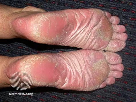 How To Treat Psoriasis On Foot Clearance | emergencydentistry.com