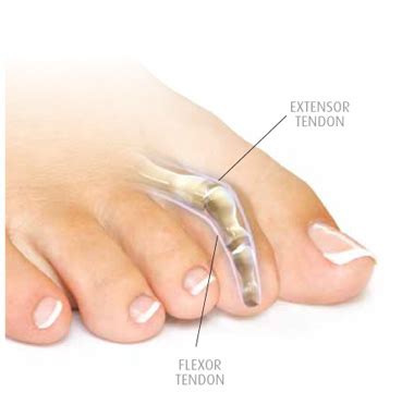 Tendon Surgery | Foot Conditions | Family Foot Care | Great Feet For Life