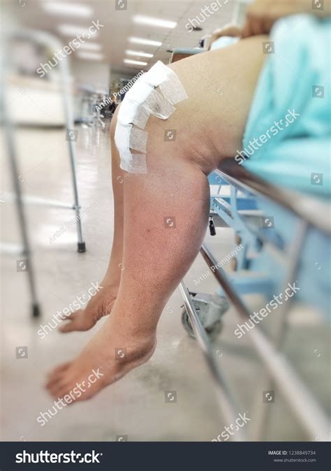 Knee Surgery Medical Treatment Knee Injuries Stock Photo (Edit Now ...