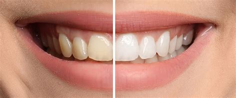 What Causes Teeth Stains (& How Do You Get Rid of Them)? - Artis Dental ...