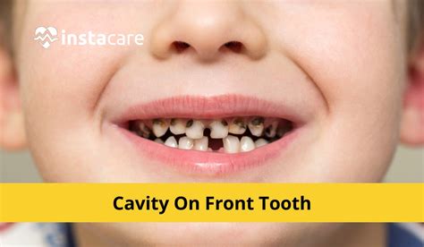 What Causes Cavity On Front Tooth?