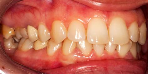 How Can You Tell if You Have Gum Disease? | Yonge Eglinton Dental