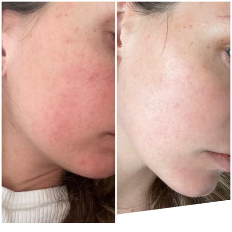 Rosacea/TSW and perioral dermatitis : r/Rosacea