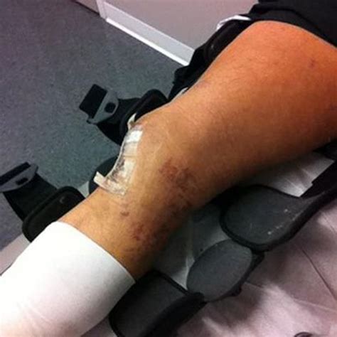 Tyson Kidd's knee injury looks pretty nasty. As he tweeted today, "This ...