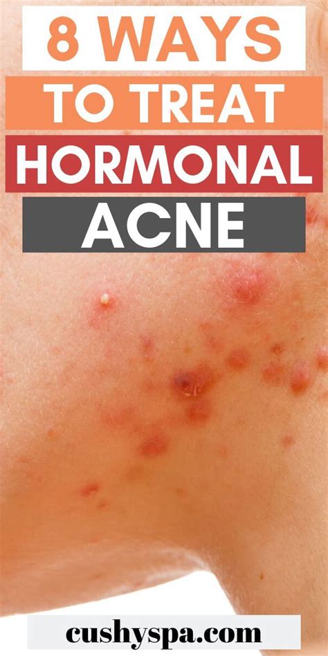 How to treat hormonal acne naturally 8 treatments – Artofit