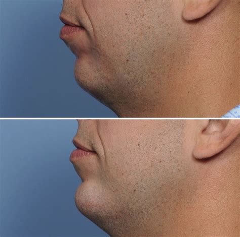 Nonsurgical Chin Augmentation