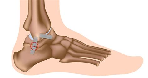 Sprained Ankle - Treatment, Rehabilitation & Exercises