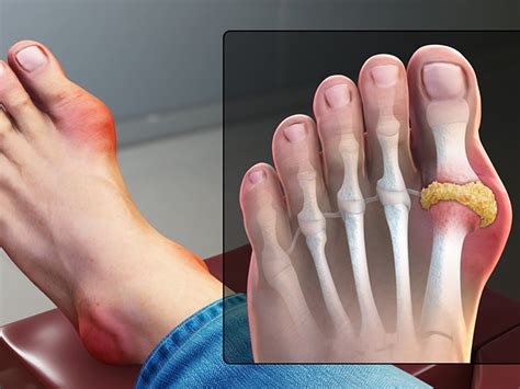 Gout in big toe: How to identify, causes, and treatment