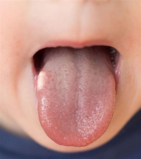 Bumps on tongue – Artofit