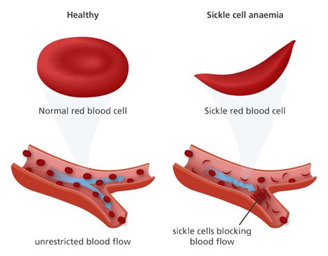 1 in 1000 Hispanic Babies Are Born with Sickle Cell Anemia