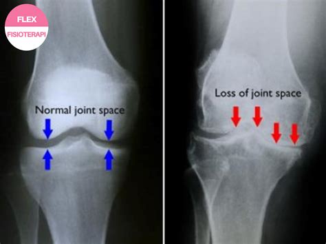 FLEX PHYSIOTHERAPY: Perbezaan Antara Sakit Lutut Osteoarthritis Dengan ...