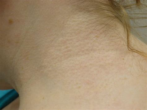 Yellow Papules on Neck and Arms - Clinical Advisor