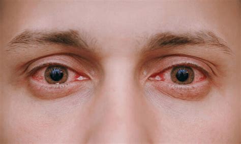 What are the most common eye diseases in humans?