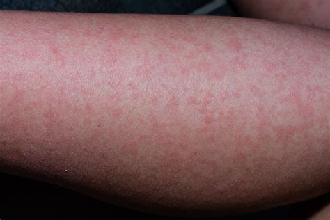 Fifths Disease Rash In Adults