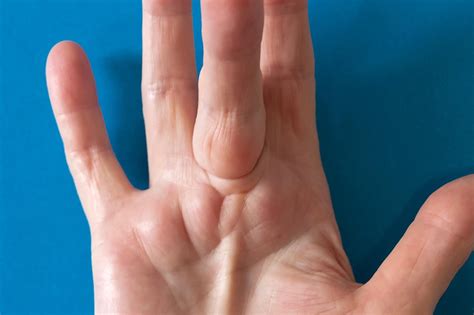 Dupuytren's contracture - NHS