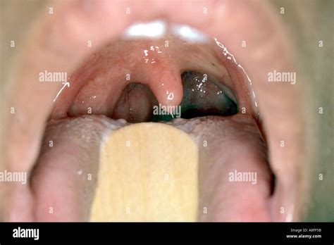 Retropharyngeal abscess Stock Photo - Alamy