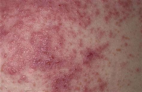 Hoe dermatitis herpetiformis eruit ziet? - Med NL
