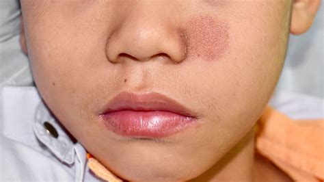 Nummular Eczema: Pictures, Treatment, and More