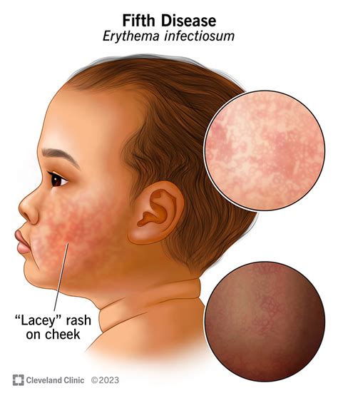 Fifths Disease On Face