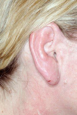 Cellulitis of the ear - Stock Image - C023/4292 - Science Photo Library