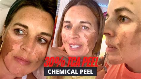 BEFORE AND AFTER 30% TCA Chemical Peel: Procedure, Peeling, Herpes - YouTube