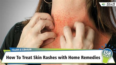 How To Treat Skin Rashes with Home Remedies | ISH News - YouTube